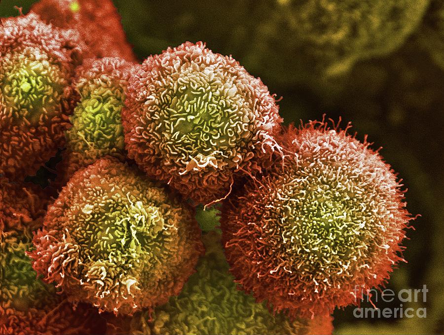 Pancreatic Cancer Cells Photograph by Anne Weston, Francis Crick