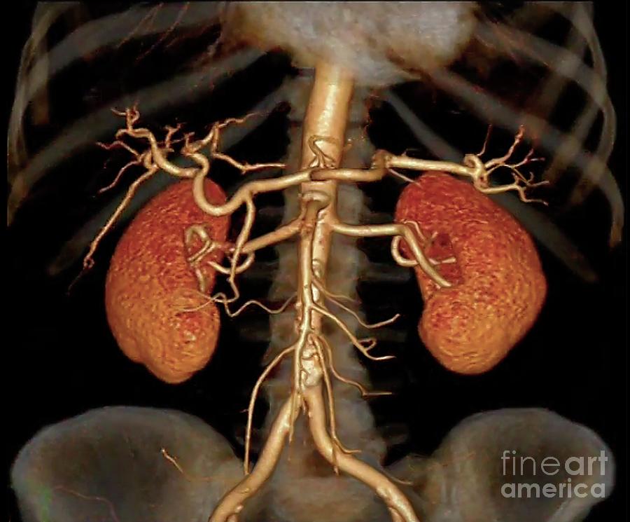 Angiogram Photograph - Healthy Kidneys #18 by Zephyr/science Photo Library