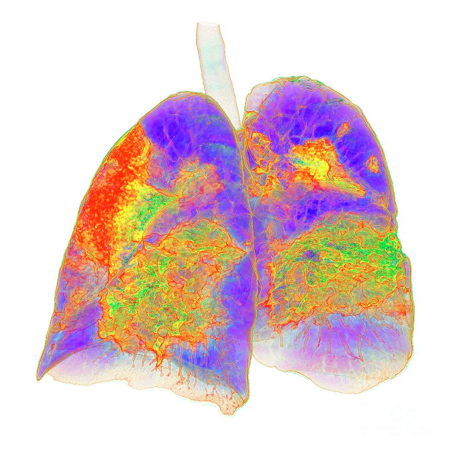 Lungs Affected By Covid-19 Atypical Pneumonia Photograph by K H Fung ...