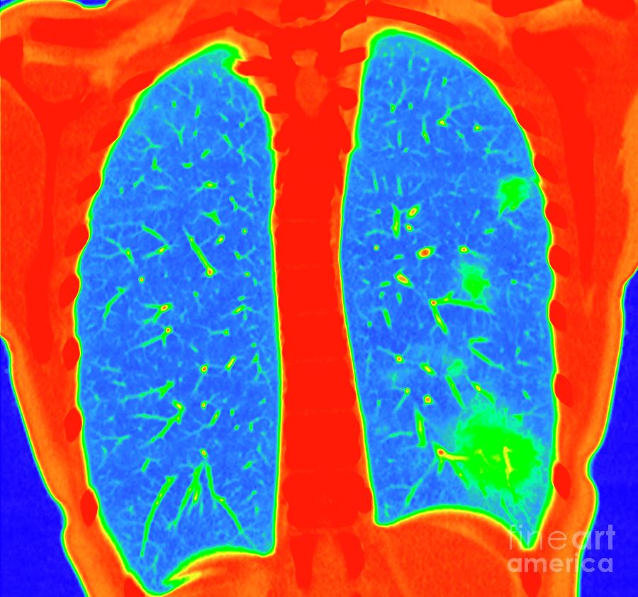 Lungs Affected By Covid-19 Pneumonia Photograph By Vsevolod Zviryk 