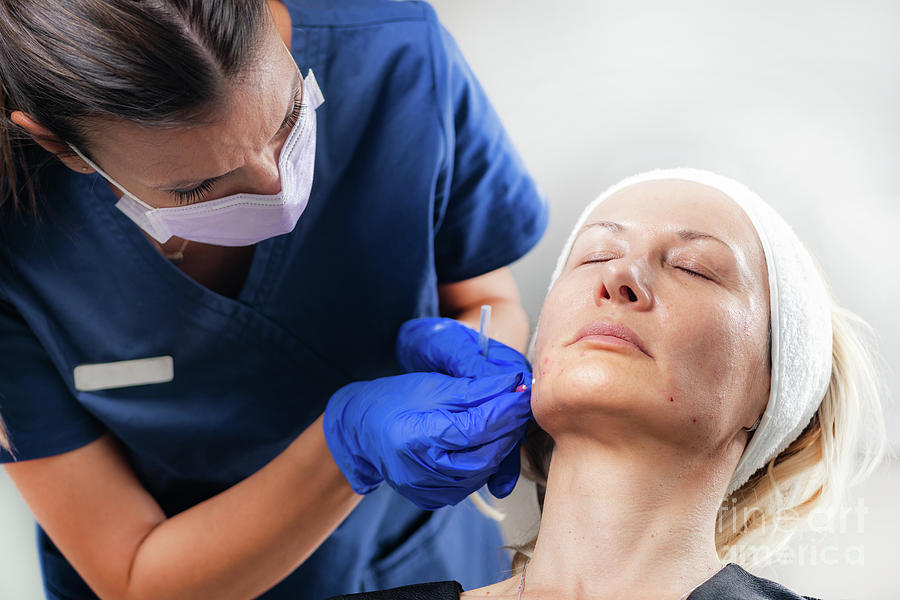 Mesotherapy Thread Face Lift Procedure #18 Photograph by Microgen Images/science Photo Library