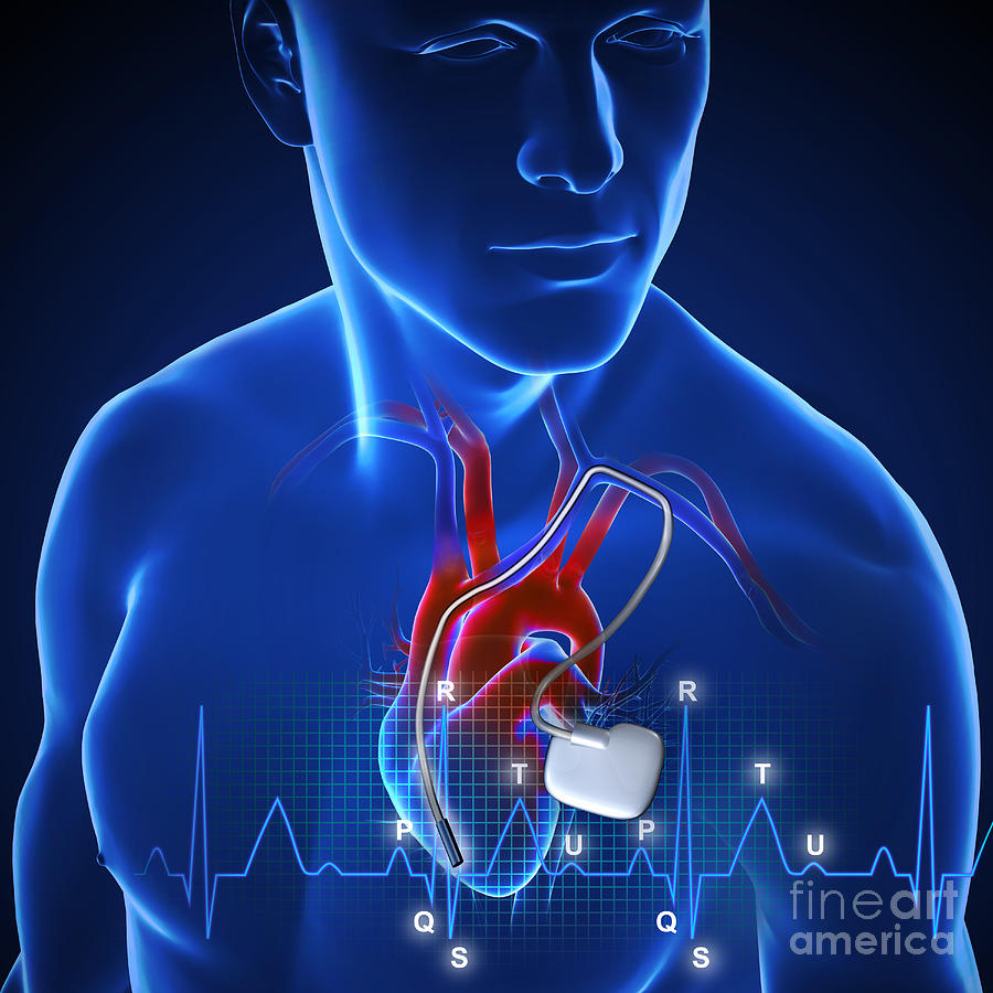 Pacemaker Photograph By Fernando Da Cunha/science Photo Library - Fine ...