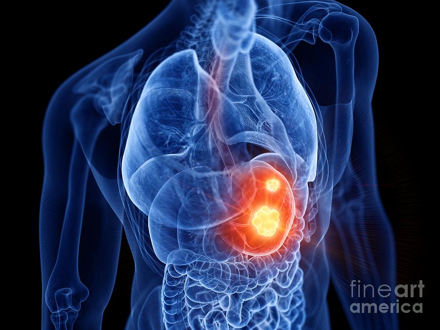 Stomach Cancer #18 Photograph by Sebastian Kaulitzki/science Photo Library