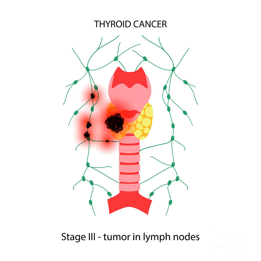 Thyroid Cancer Photograph by Pikovit / Science Photo Library - Fine Art ...