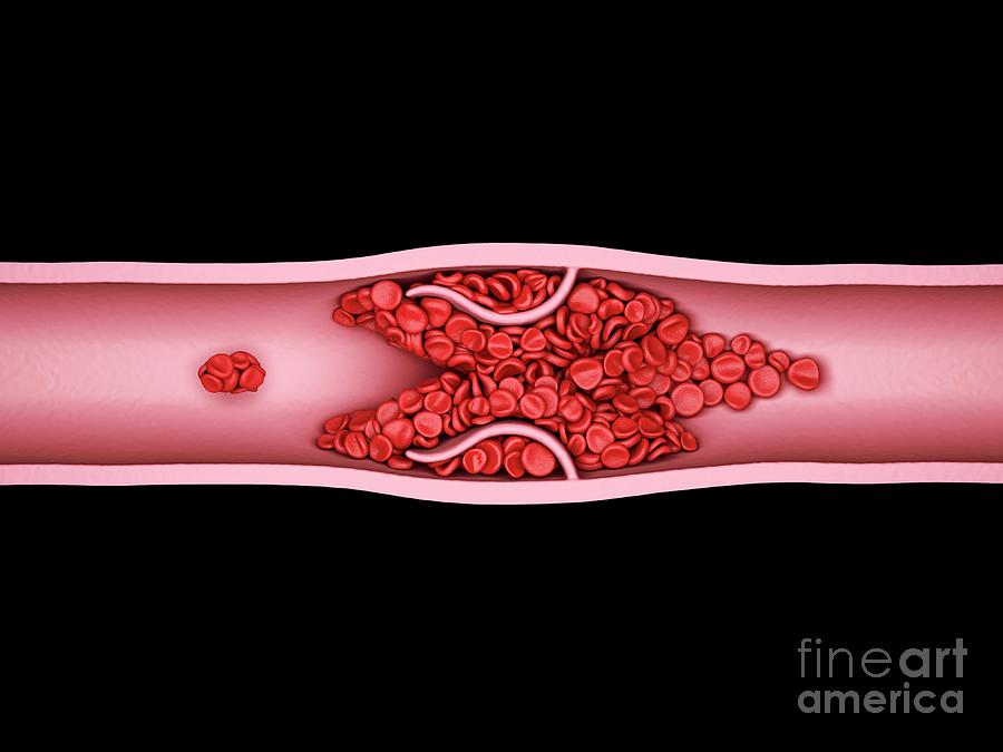 Blood Clot #19 Photograph by Maurizio De Angelis/science Photo Library