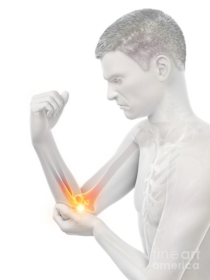 Elbow Photograph - Elbow Pain #19 by Sebastian Kaulitzki/science Photo Library