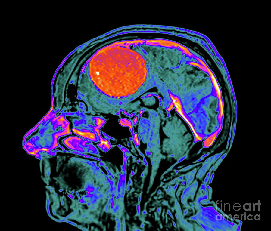 Meningioma Brain Tumour #19 Photograph by Zephyr/science Photo Library