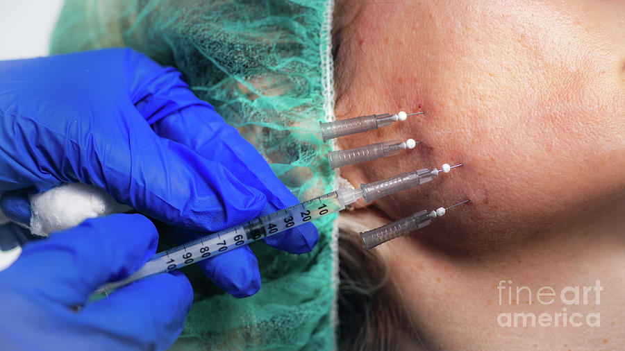 Mesotherapy Thread Face Lift Procedure #19 Photograph by Microgen Images/science Photo Library