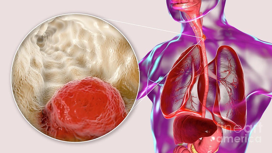 Oesophageal Cancer Photograph by Kateryna Kon/science Photo Library ...