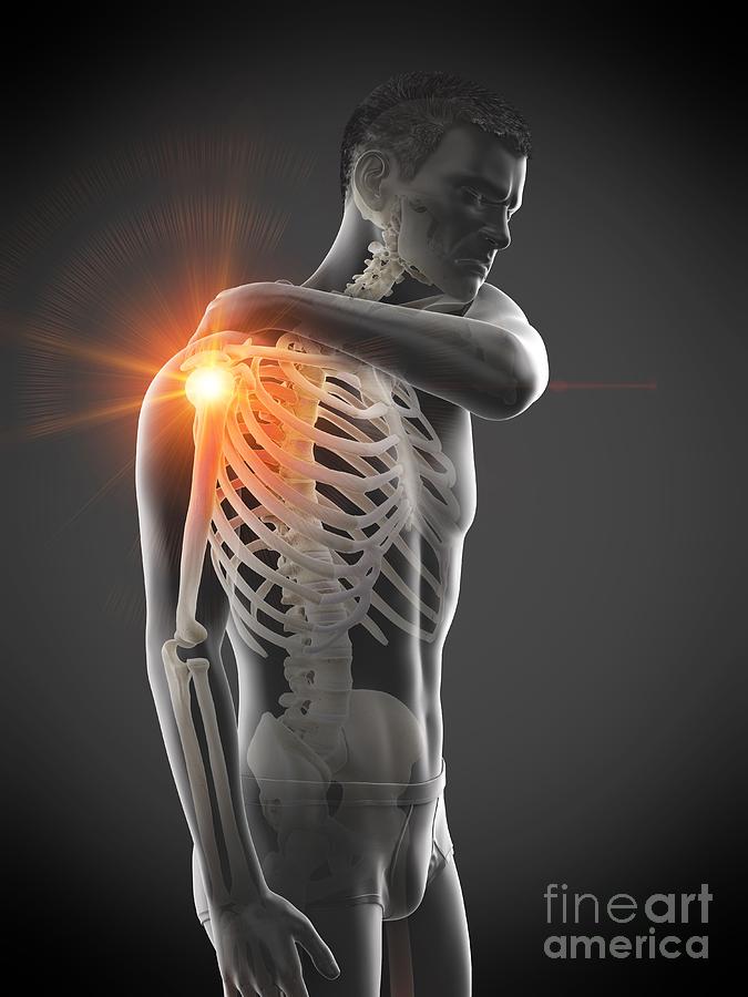 3d Photograph - Shoulder Pain #19 by Sebastian Kaulitzki/science Photo Library