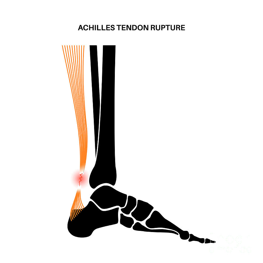 Achilles Tendinopathy: A Common Source Of Foot Pain:, 52% OFF