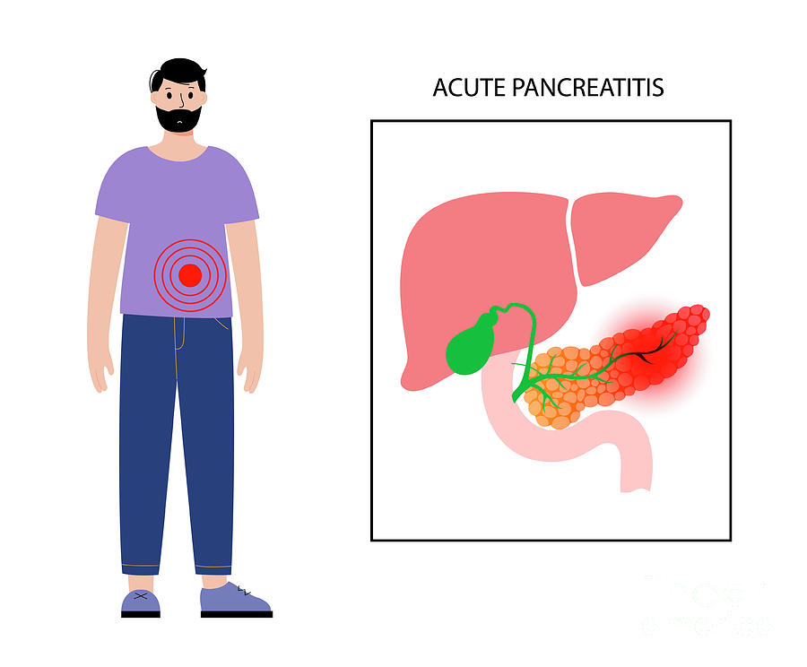 Acute Pancreatitis #2 Photograph by Pikovit / Science Photo Library