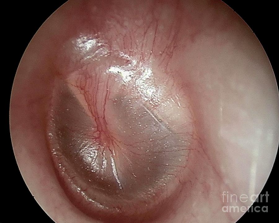 Acute Viral Otitis #2 Photograph by Professor Tony Wright, Institute Of Laryngology & Otology/science Photo Library