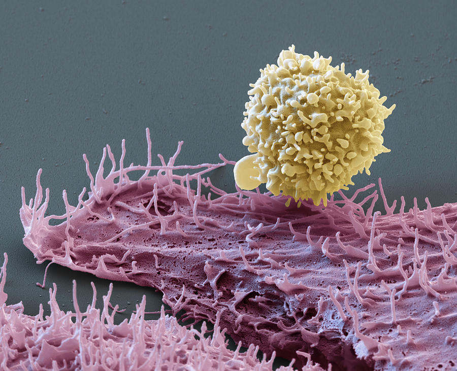 Adenocarcinoma Cell, Sem Photograph by Oliver Meckes EYE OF SCIENCE ...