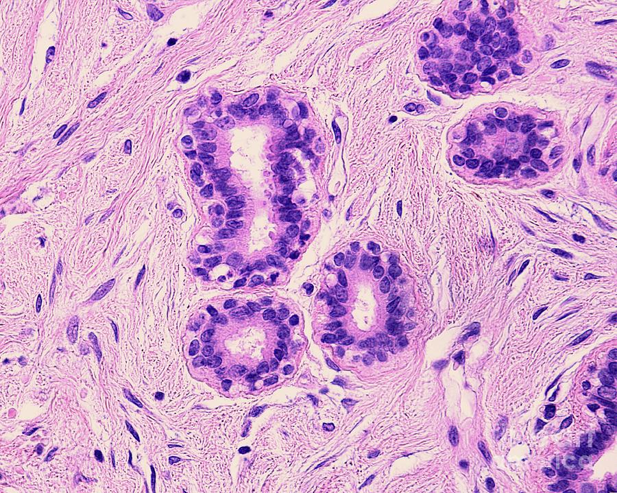 Adenosis Of Human Breast #2 Photograph by Jose Calvo/science Photo Library