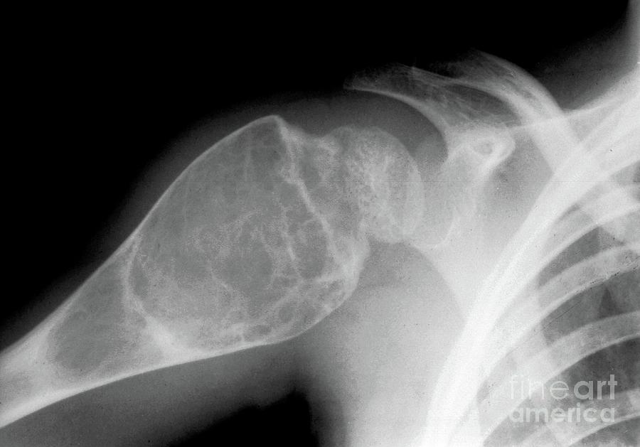 Aneurysmal Bone Cyst #2 Photograph by Zephyr/science Photo Library