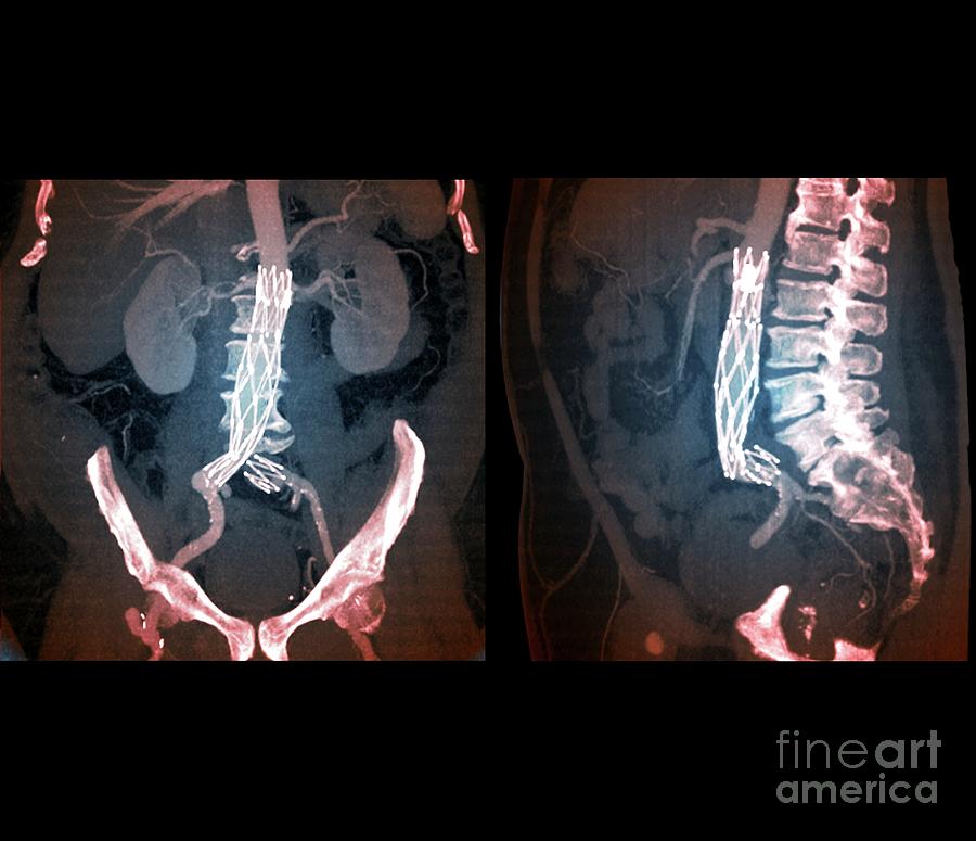 Aortic Aneurysm Stent Photograph By Zephyrscience Photo Library Pixels 8112