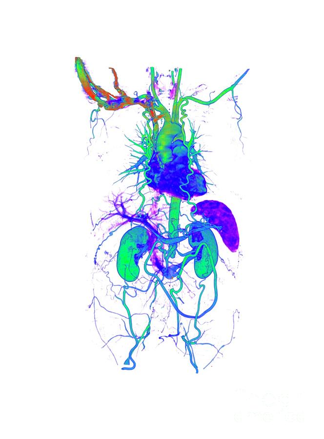 Aortoiliac Occlusive Disease #2 Photograph by Vsevolod Zviryk/science ...