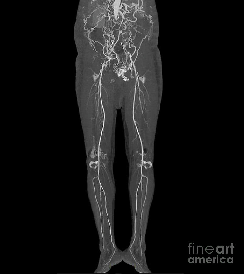 Aortoiliac Occlusive Disease Photograph By Zephyr/science Photo Library ...