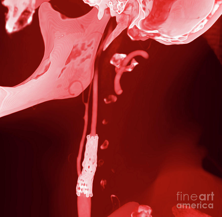 Arterial Stent #2 Photograph by Vsevolod Zviryk/science Photo Library