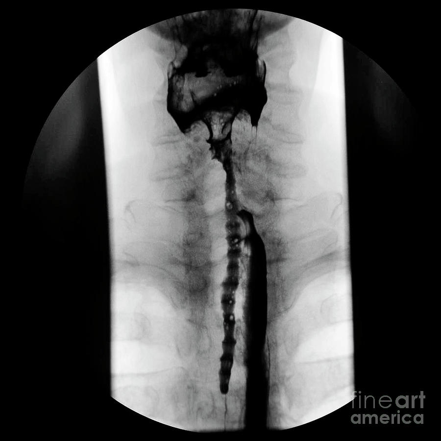 Disease Photograph - Aspiration During Barium Swallow Examination #2 by Science Photo Library
