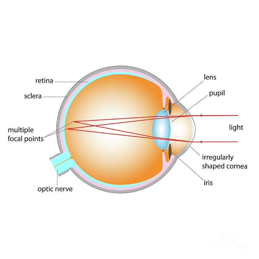 Astigmatism Photograph by Cordelia Molloy/science Photo Library - Fine ...