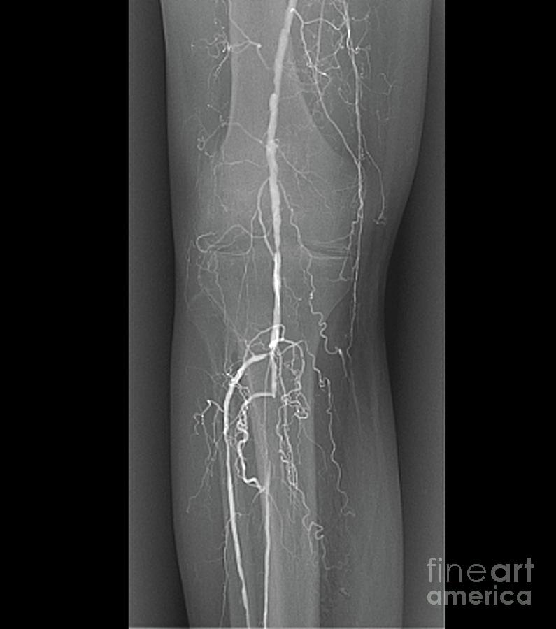 Blocked Leg Artery #2 Photograph by Zephyr/science Photo Library