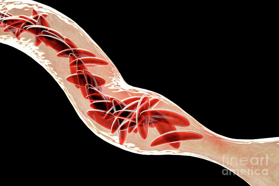 Blood Vessel Blocked In Sickle Cell Anaemia Photograph by Kateryna Kon ...