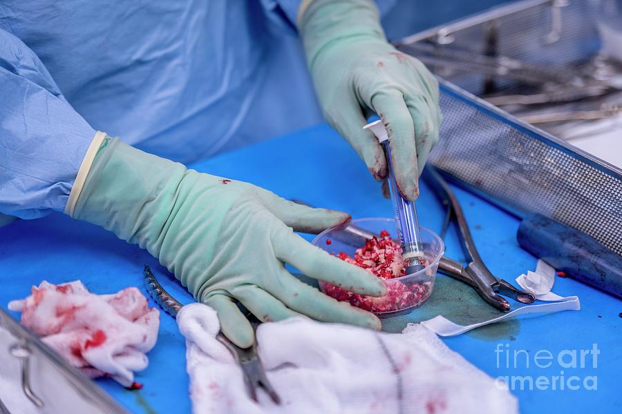Bone Graft Preparation During Spinal Surgery #2 Photograph by Jim Varney/science Photo Library