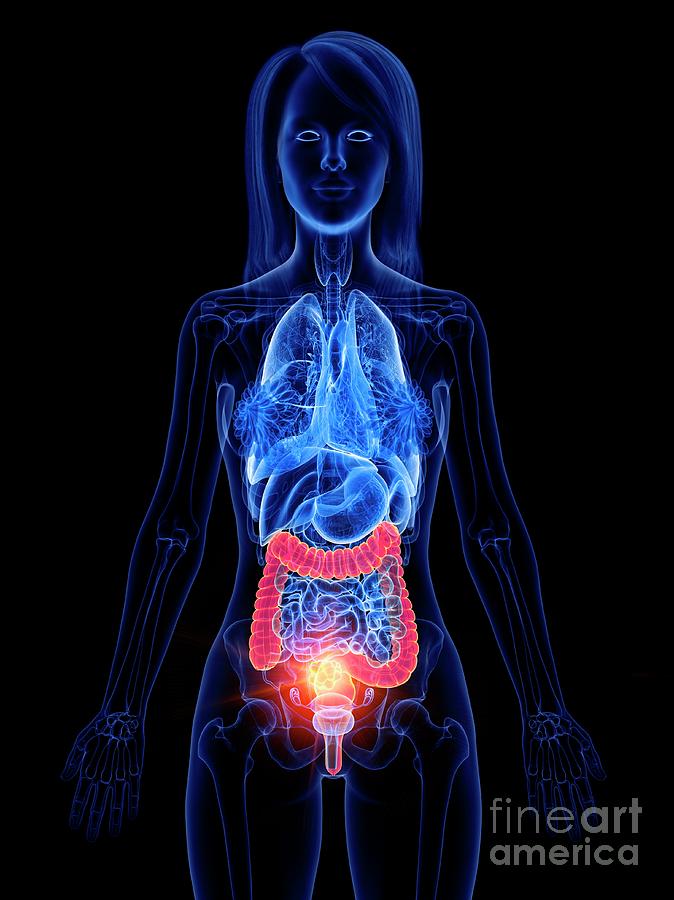 Bowel Cancer Photograph By Sebastian Kaulitzki/science Photo Library ...