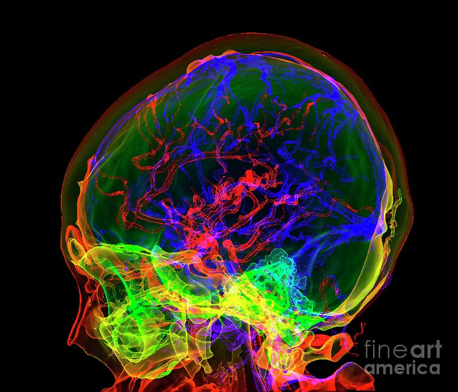 Brain Blood Vessels Photograph by K H Fung/science Photo Library