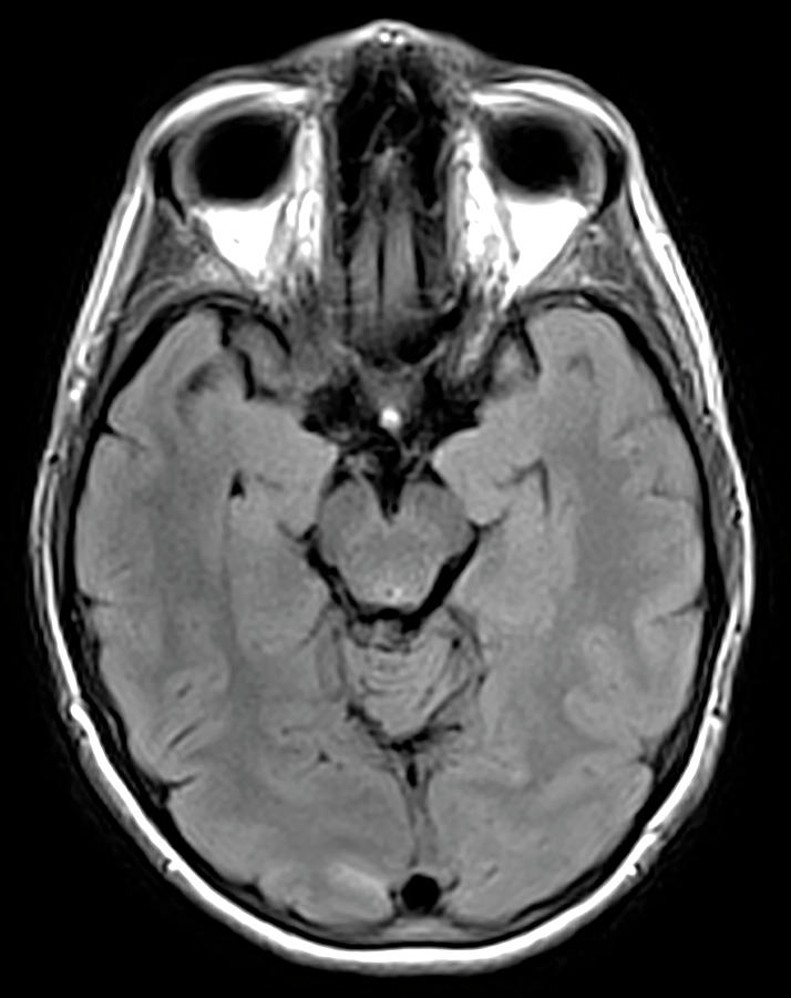 Brain Cancer Treated, Mri #2 Photograph by Steven Needell