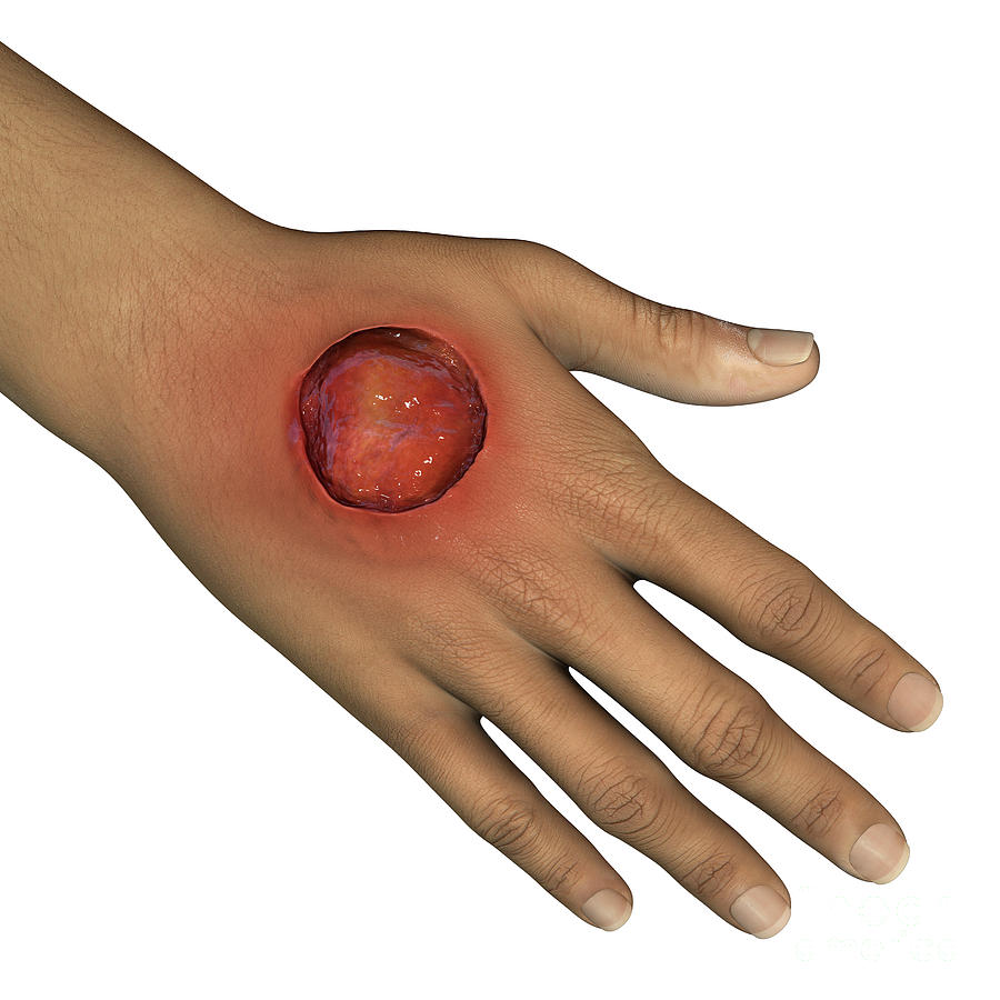 Buruli Ulcer On A Hand Photograph By Kateryna Kon/science Photo Library ...