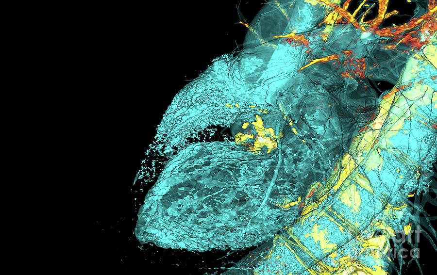 Calcified Heart Valve #2 Photograph by Vsevolod Zviryk/science Photo Library