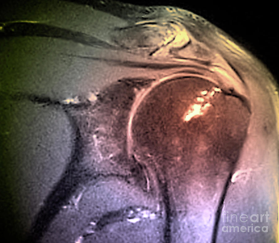 Calcified Tendinitis #2 Photograph by Zephyr/science Photo Library