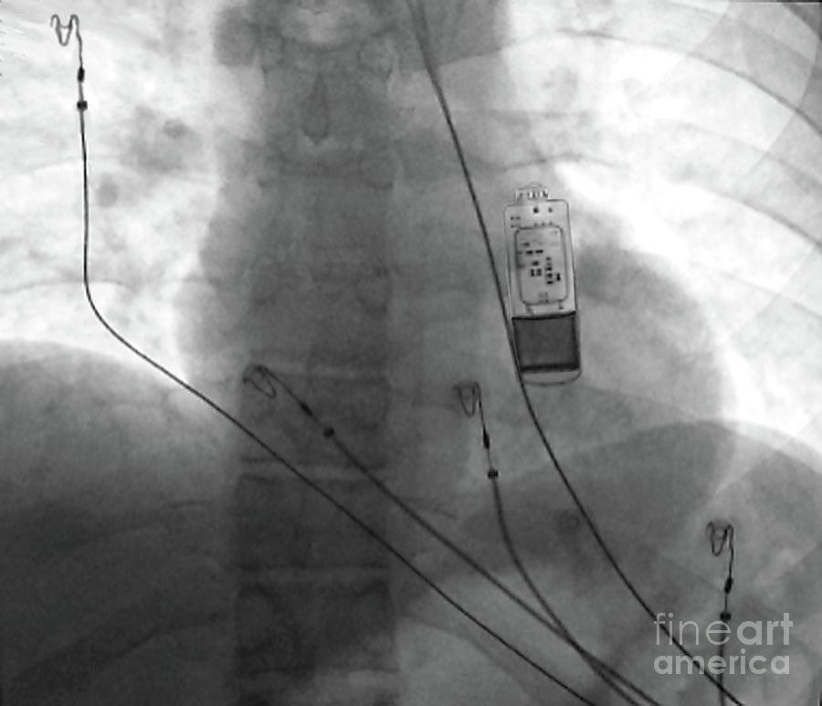 heart monitor implants
