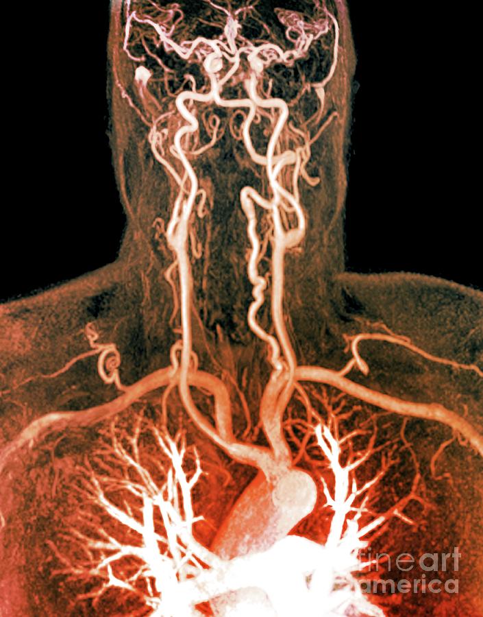 Cervical Artery Dissection #2 Photograph by Zephyr/science Photo Library