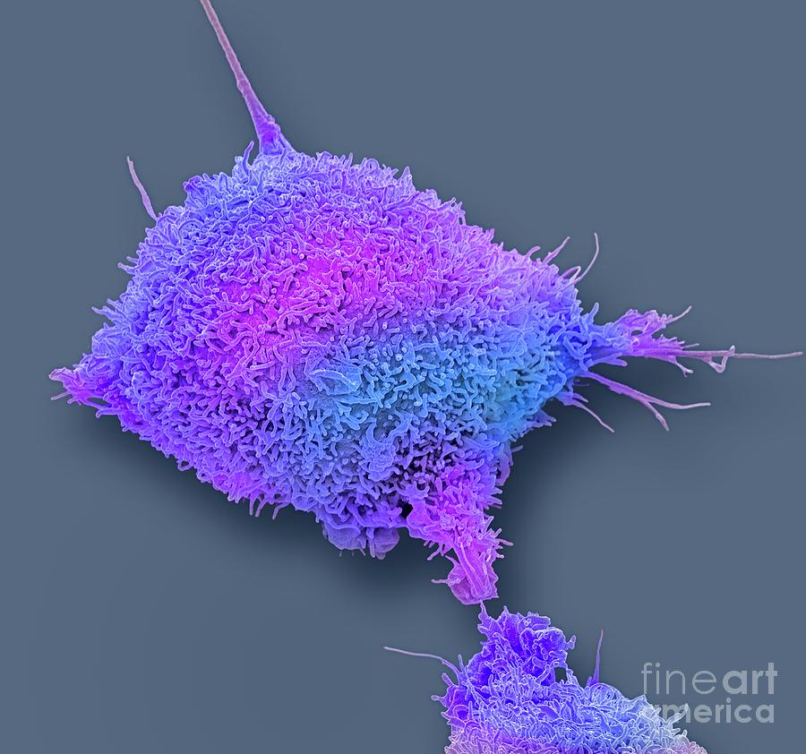 Cervical Cancer Cell Photograph By Steve Gschmeissnerscience Photo Library