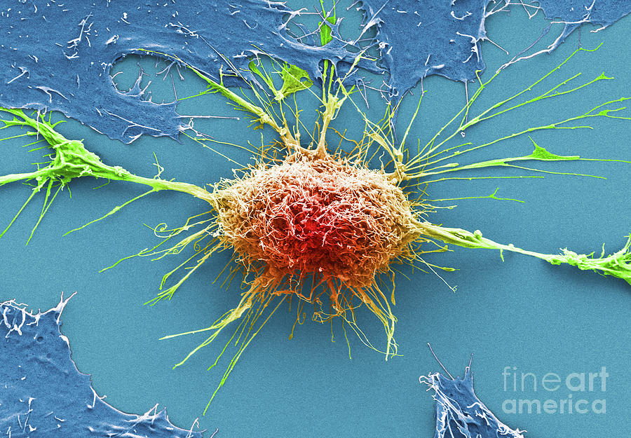 Cervical Cancer Cells Photograph by Anne E. Weston/science Photo ...