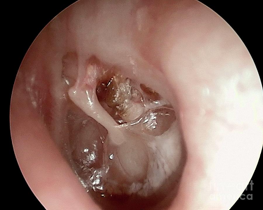 Cholesteatoma Of The Eardrum #2 Photograph by Professor Tony Wright, Institute Of Laryngology & Otology/science Photo Library