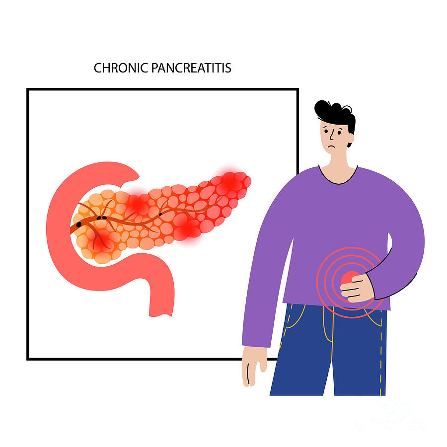 Chronic Pancreatitis #2 Photograph by Pikovit / Science Photo Library