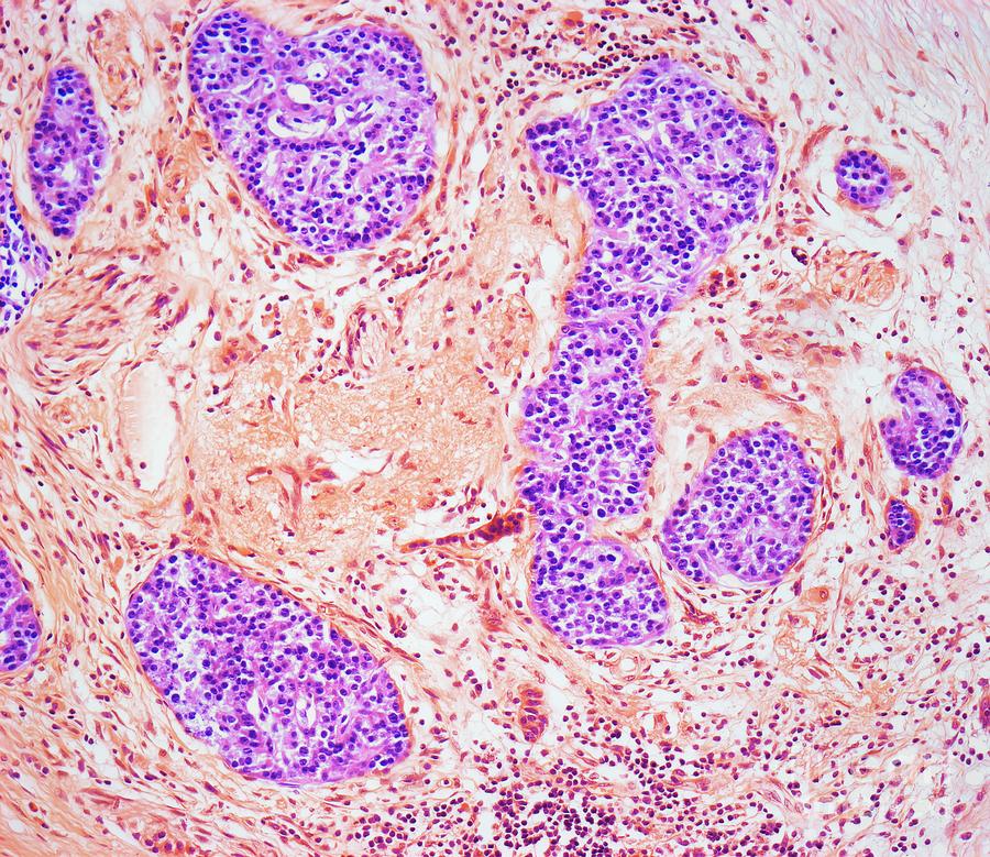 Chronic Pancreatitis #2 Photograph by Steve Gschmeissner/science Photo Library