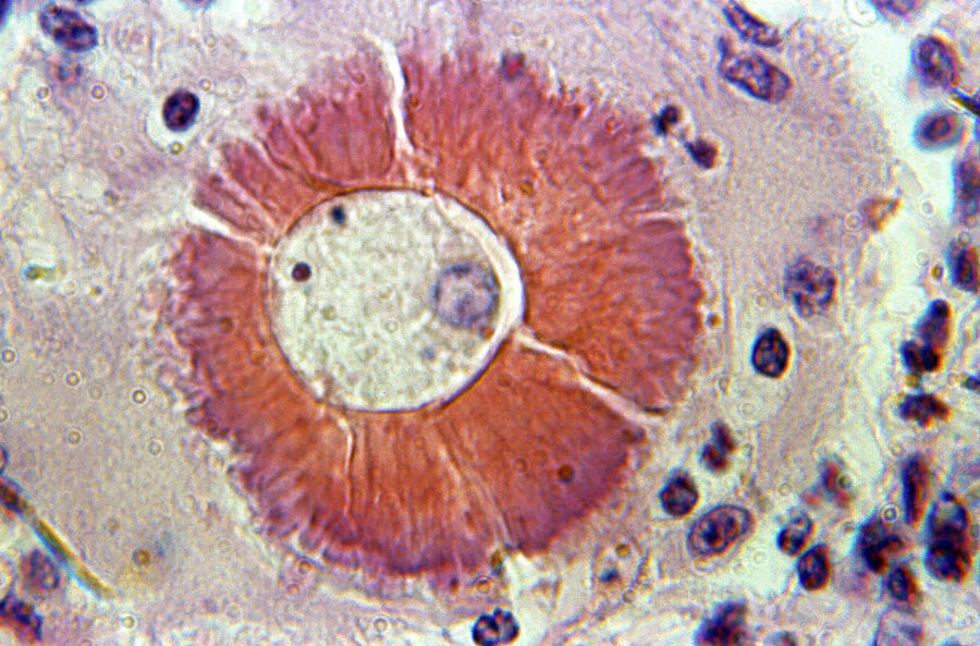 Coccidioidomycosis, Valley Fever, Lm Photograph by Science Source ...