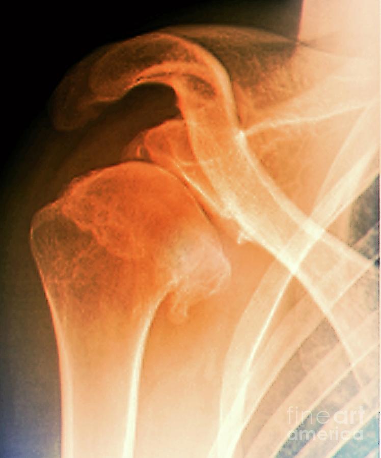 Complications Following Dislocated Shoulder In Sports Injury #2 by ...