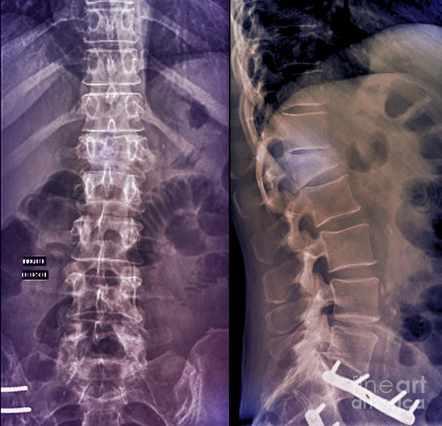 Lumbar Compression Fracture, Illustration - Stock Image - C027