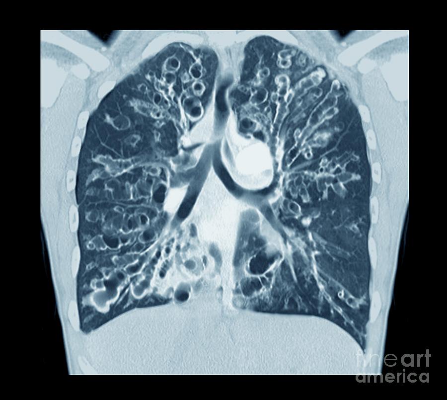 Cystic Fibrosis #2 Photograph by Zephyr/science Photo Library - Pixels