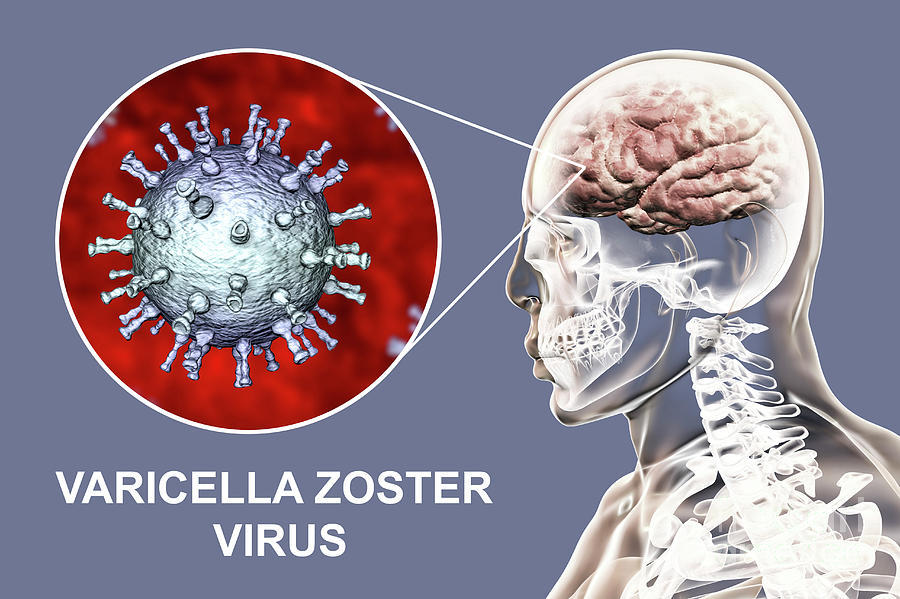 Encephalitis Caused By Varicella Zoster Virus #2 Photograph by Kateryna Kon/science Photo Library