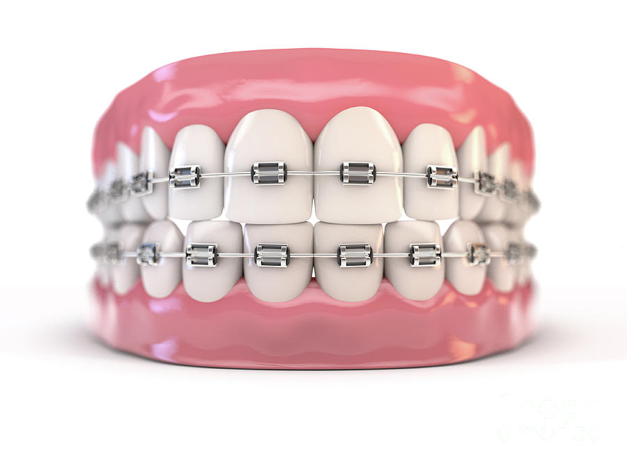 Fake Teeth Set With Braces Digital Art