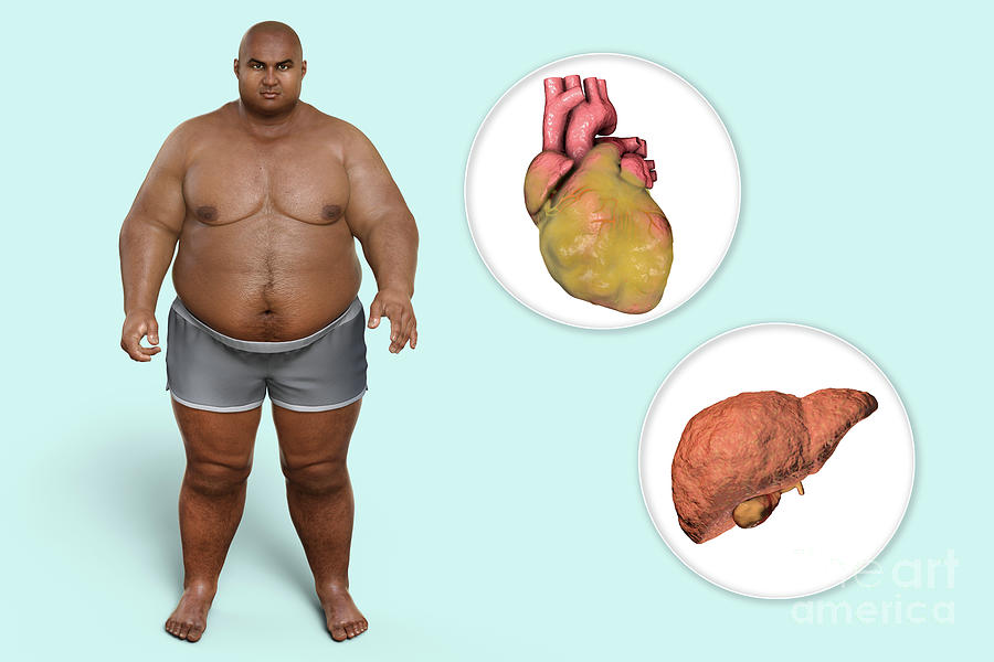 Fatty Heart And Liver In Overweight Man 2 By Kateryna Kon Science Photo Library