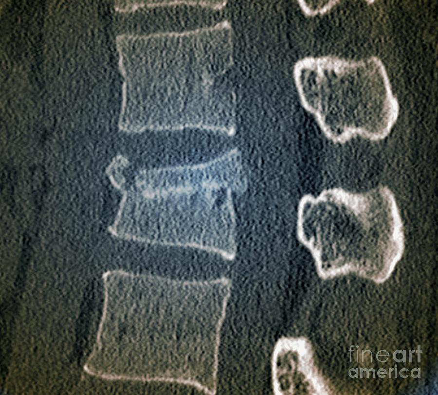 Fractured Lumbar Vertebra #2 by Zephyr/science Photo Library